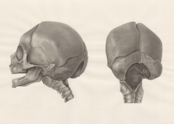 H.G Wetselaar, Deformed fetal skull, with part of the spinal cord