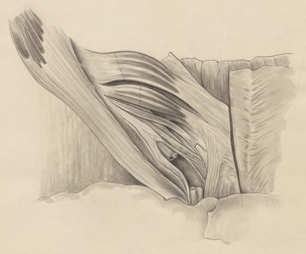J Tinkelenberg, Tissue of the inguinal