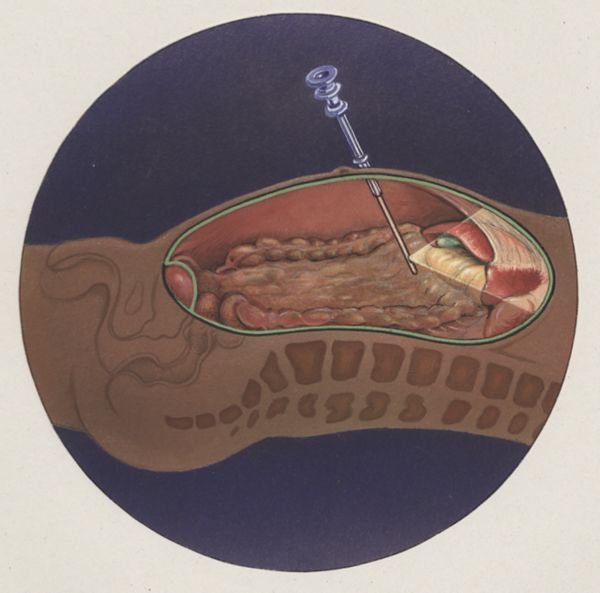 J Tinkelenberg, Laparoscopy