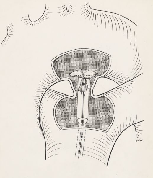 J Wetselaar-Whittaker, Surgically closing a duct