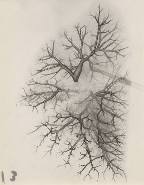 J Tinkelenberg, Bronchi