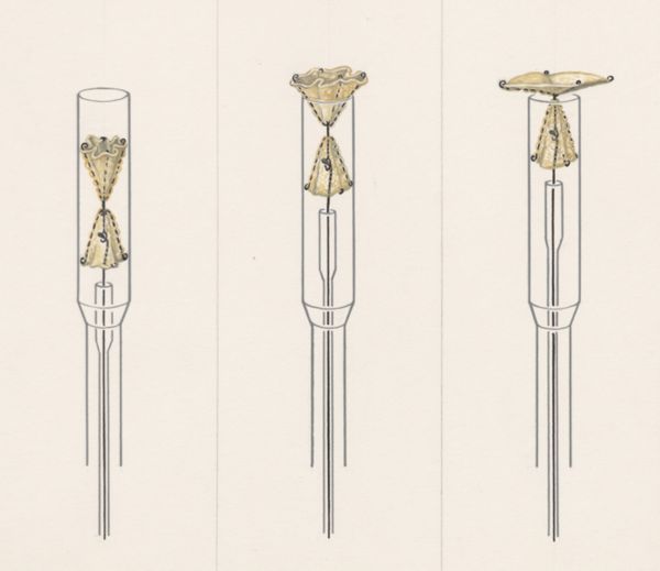J Wetselaar-Whittaker, Procedure to open the artery around the heart of young children, devised by Dr. J. Rohmer