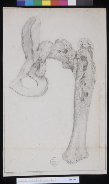 M Houtman, Pathology, fractures (Upper femur)