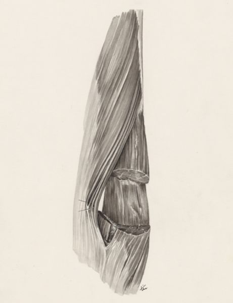 J Tinkelenberg, Muscular tissue