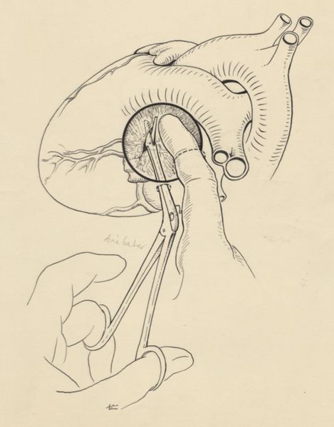 J Tinkelenberg, Scissors cutting through tissue of the heart