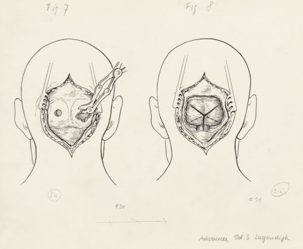 J Tinkelenberg, Neurosurgical Procedures