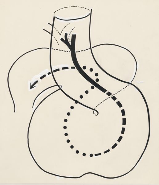 J Tinkelenberg, Schematic representation of a part of the heart