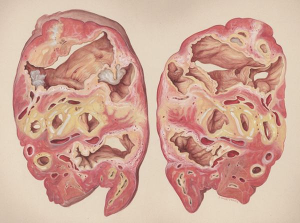 J Wetselaar-Whittaker, Lung tissue
