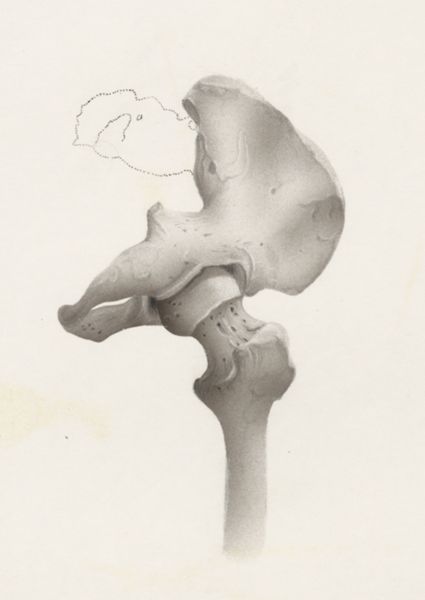 Harry de Bles, Hip joint