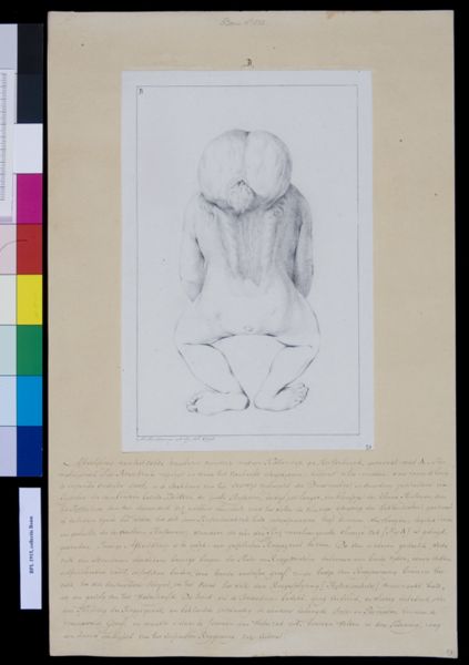 M. Houtman, Deformed foetus