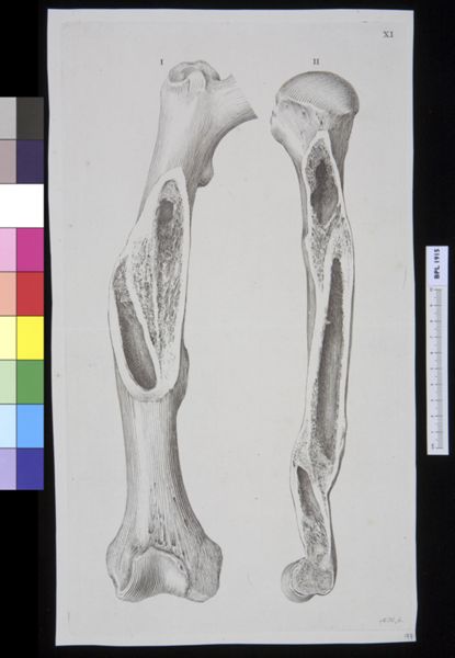 M Houtman, Infected bone (femur?)