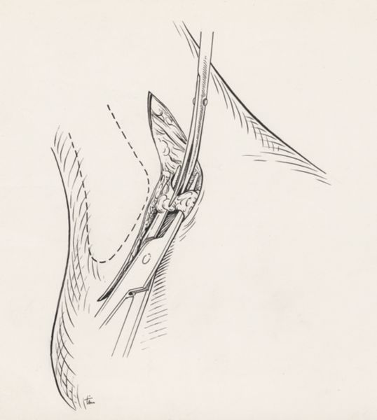 J Tinkelenberg, Surgery of the ankle ligament