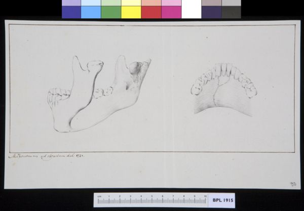 M Houtman, Lower jaw, fracture