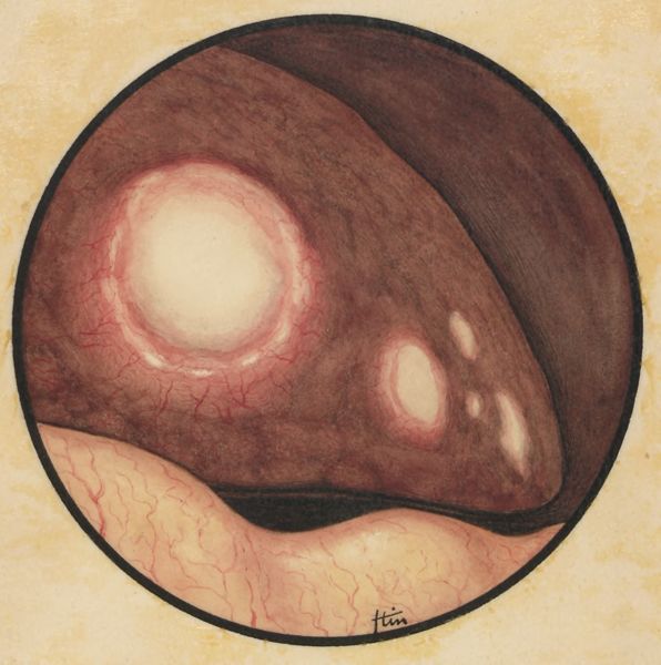 J Tinkelenberg, Microscopic magnification of an inflammation on human tissue
