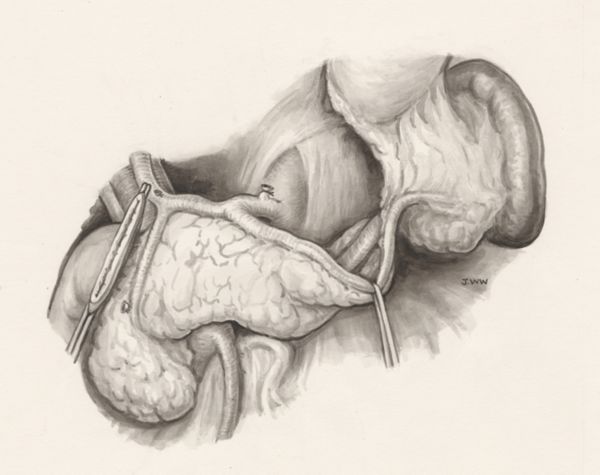 J Wetselaar-Whittaker, Operation on human tissue