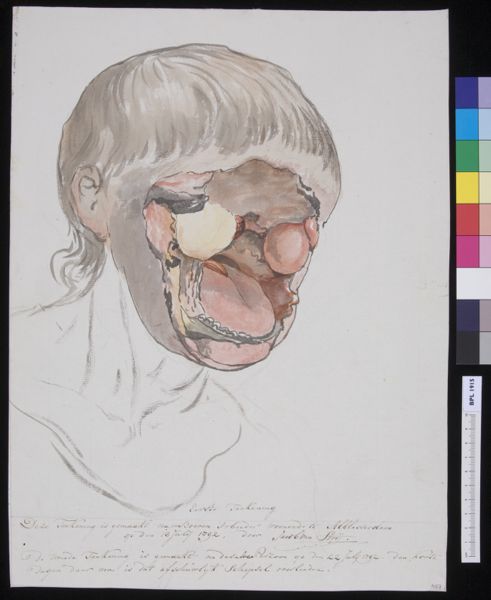 Jacob van Strij, Man with severly deformed face