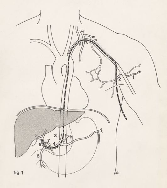 J Tinkelenberg, Schematic representation of internal oncology