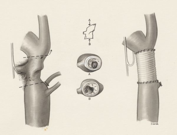 J Wetselaar-Whittaker, Heart surgery