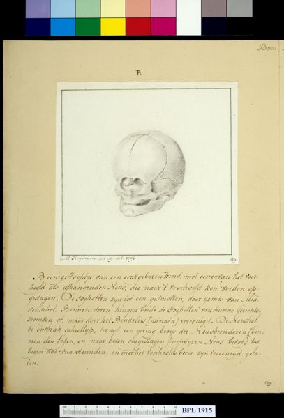 M Houtman, Skull of child with deformed head