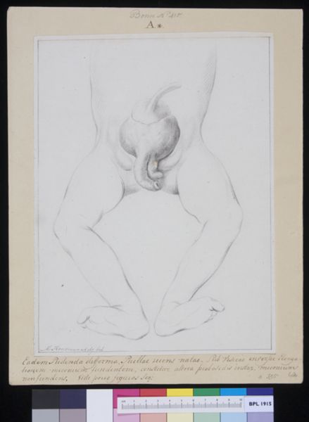 M Houtman, Deformed pubic area in a girl