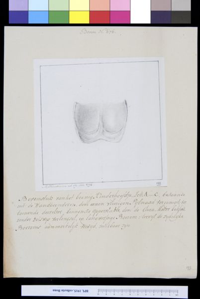 M. Houtman, Part of skull of child with deformed head