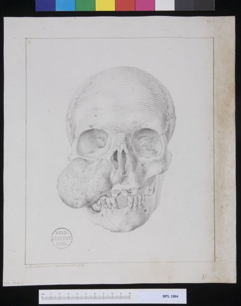 M Houtman, Pathology, fractures (Skull of the woman with a tumor in her cheek)