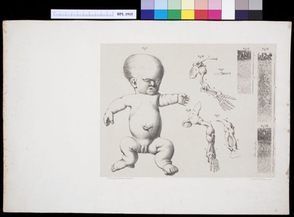 Tiemen Hooiberg, Teratology, foetus