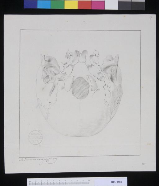 M Houtman, Pathology, fractures