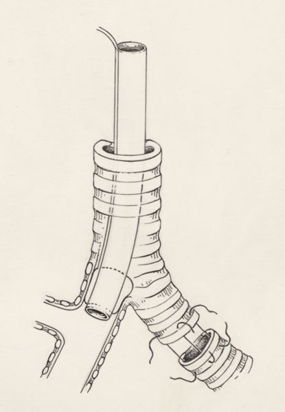 J Tinkelenberg, Thorax surgery