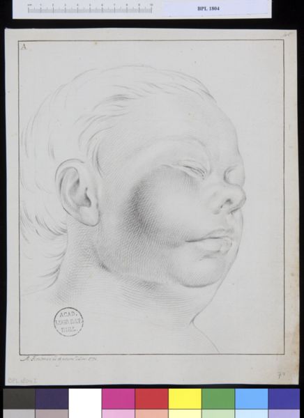 M Houtman, Pathology, fractures (Head of the woman with a tumor in her cheek)