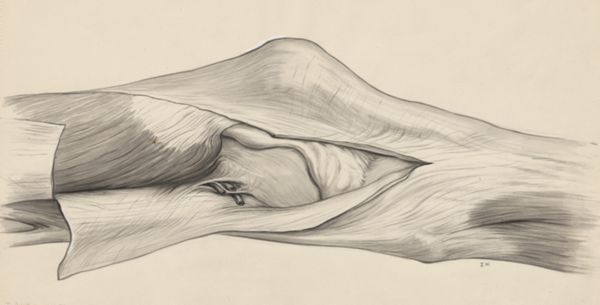 J Wetselaar-Whittaker, Knee joint