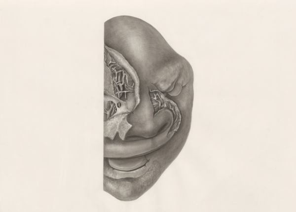 H.G Wetselaar, Deformed fetal head, partly seen from the front