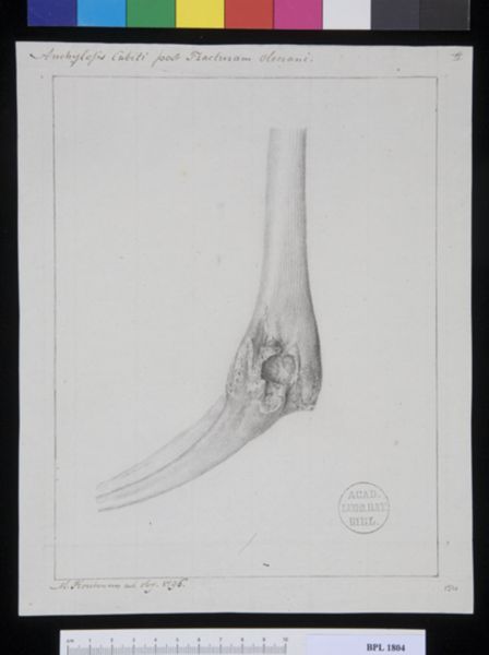 M. Houtman, Pathology, fractures (Ankylosis)