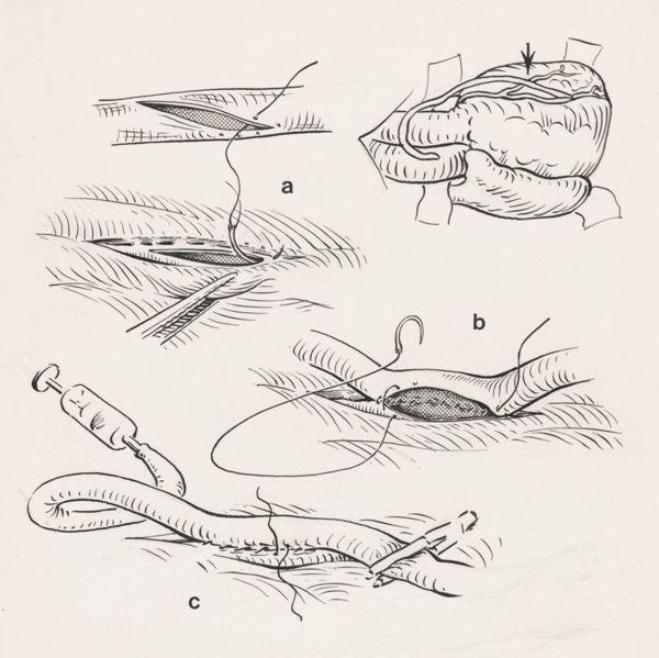 J Tinkelenberg, Thorax surgery
