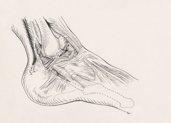J Tinkelenberg, Torn ankle ligament