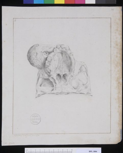 M Houtman, Pathology, fractures (Tumor from a woman's cheek seen from below)