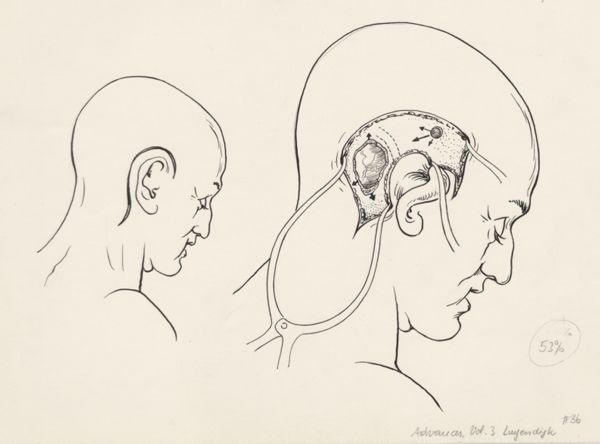 J Tinkelenberg, Neurosurgical Procedures