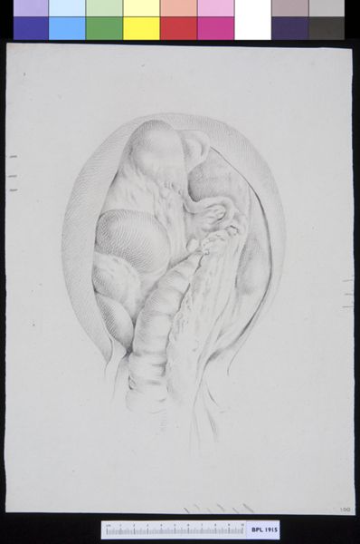 M Houtman, Inguinal hernia