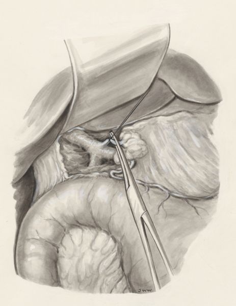 J Wetselaar-Whittaker, Part of the human body, opened with medical clamps