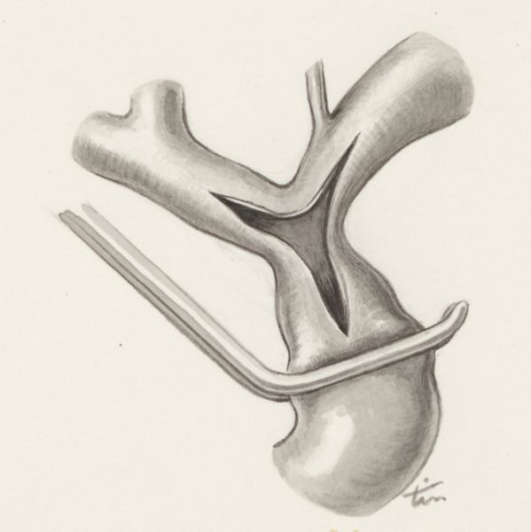 H.G Wetselaar, Thorax surgery