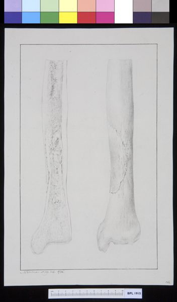 M Houtman, Infected bone plus cross section
