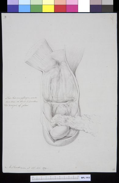 M Houtman, Inguinal hernia
