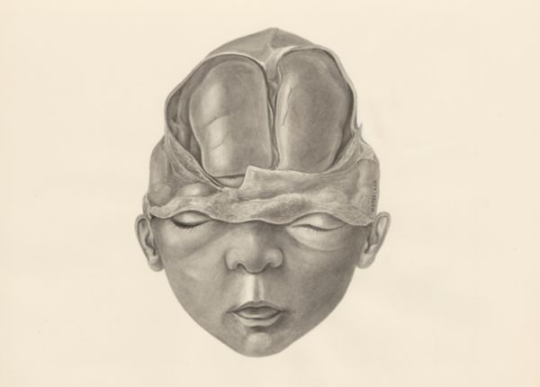 H.G Wetselaar, Deformed fetal head