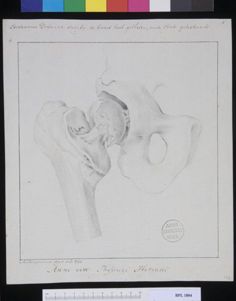 M Houtman, Pathology, fractures (Broken femoral head)