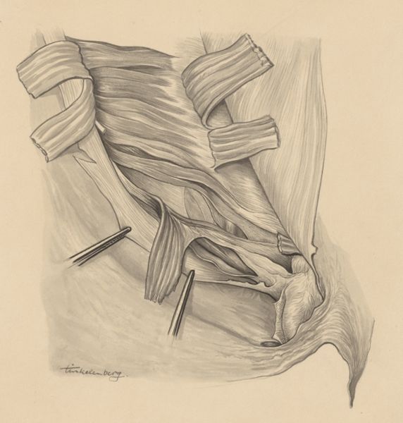 J Tinkelenberg, Tissue of the inguinal