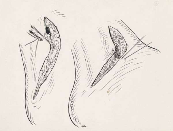 J Tinkelenberg, Surgery of the ankle ligament