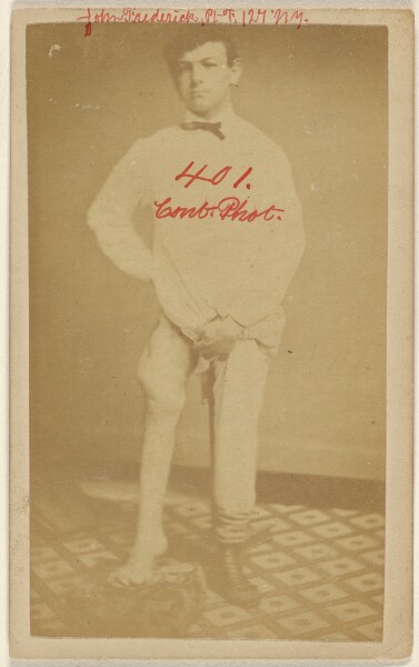 Unknown, No.1 Case of John Frederick U.S.V. Front View. Limb Shortened Seven Inches.