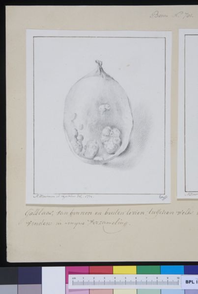 M Houtman, Gallbladder with stones