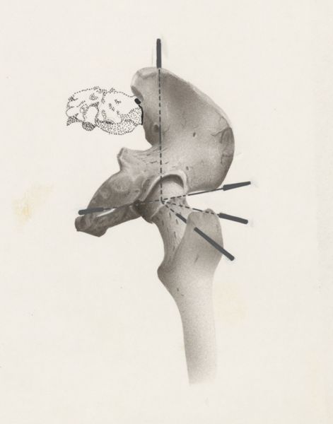 Harry de Bles, Hip joint