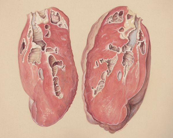 J Wetselaar-Whittaker, Lung tissue